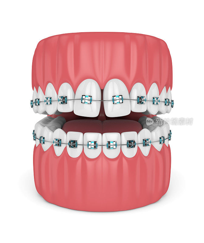 牙齿的发散牙缝和牙套的3d渲染