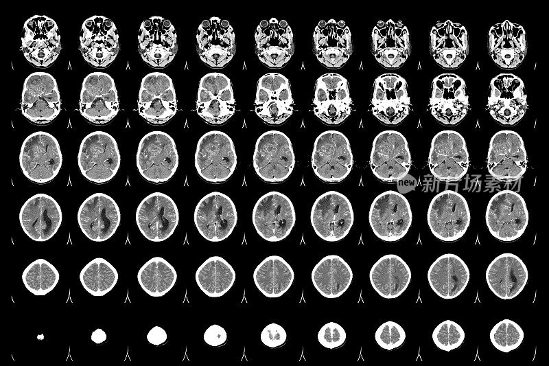 CT扫描脑轴位图用于诊断脑肿瘤。恶性胶质瘤，脑转移等密度肿块，边缘不清，右额叶周围水肿。