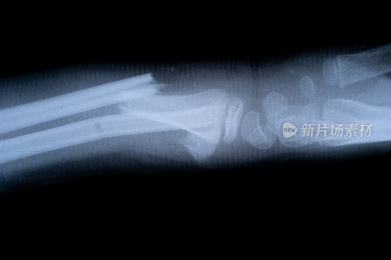 x光片骨骼人体手臂。健康医学解剖身体概念