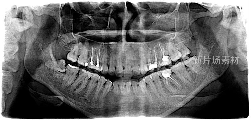 x射线的牙齿