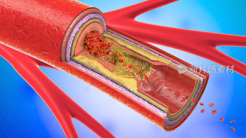 淤积的、狭窄的血管或动脉硬化的三维图示