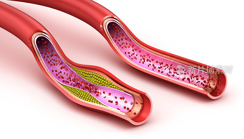 血管:正常和胆固醇受损的血管。三维渲染