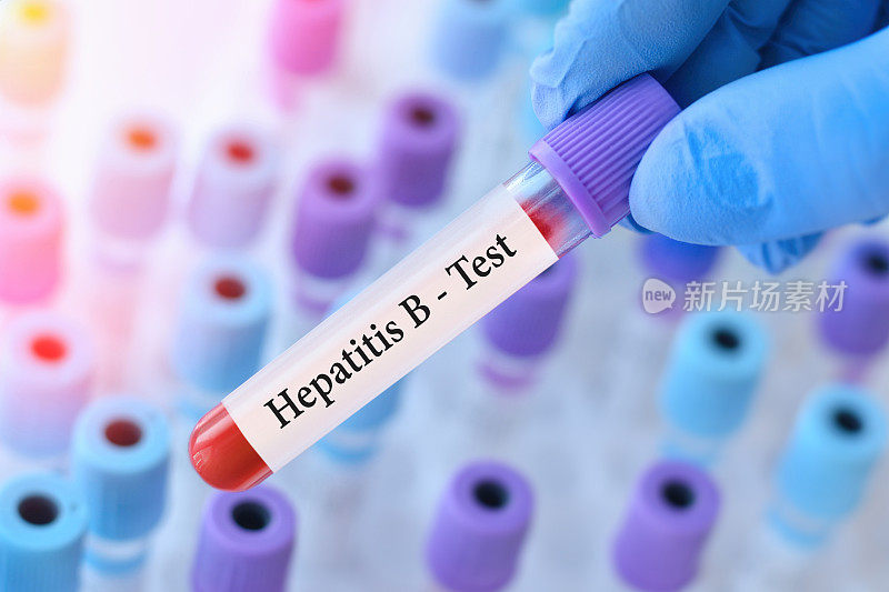 在医用试管的背景下，医生拿着检测乙型肝炎病毒(HBV)的血样管