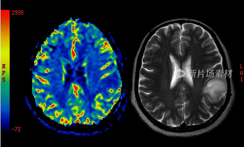 良性脑肿瘤的MRI灌注成像