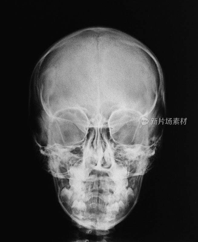 x射线的头骨