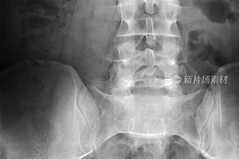 腰椎、骶骨和髂骶骨关节x线片