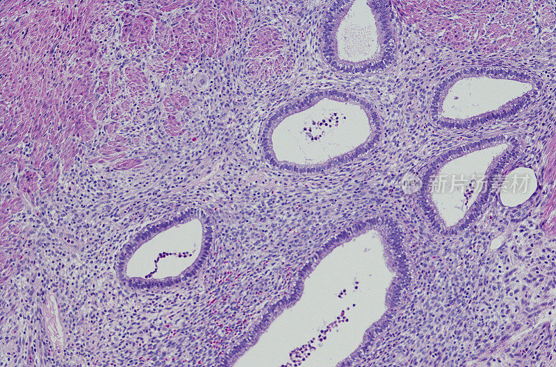 阑尾子宫内膜异位症的显微照片