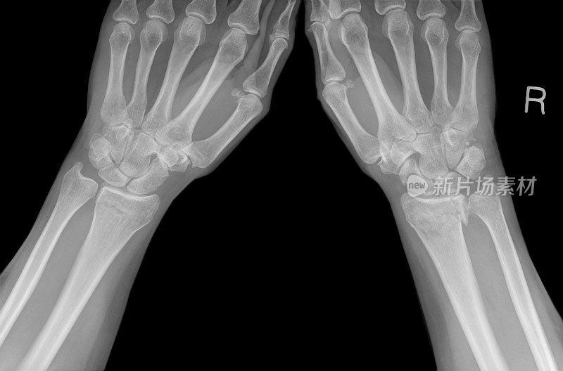 绝经后骨质疏松症中colles骨折的手腕x光片