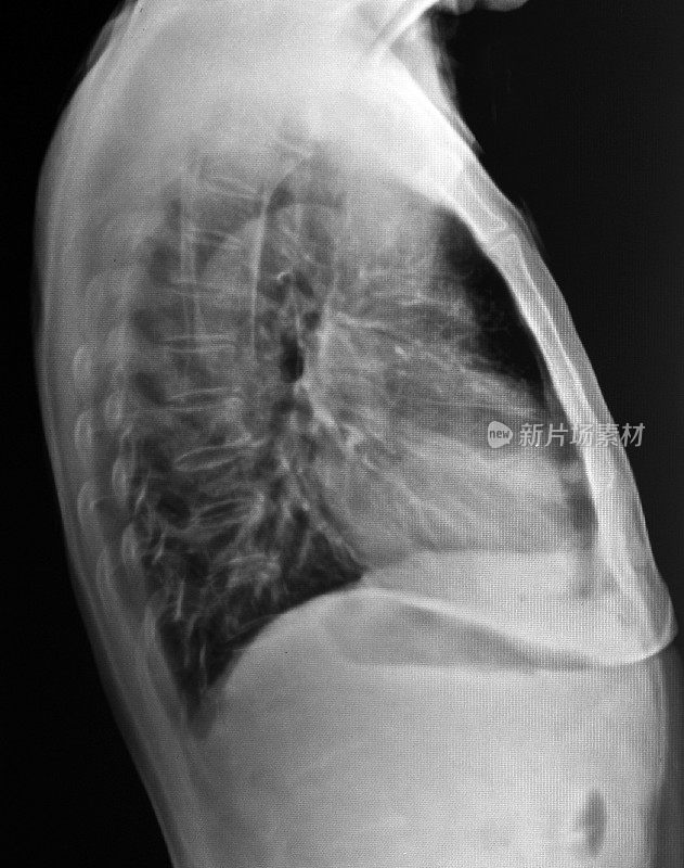 胸部x光图像