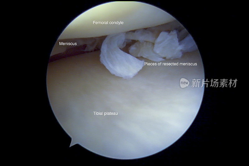 左膝内侧半月板后部复杂退行性撕裂的关节镜观察
