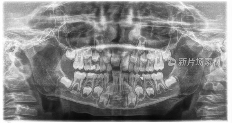 8岁男孩牙科x光片