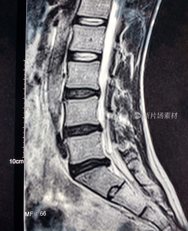 腰椎L5-S1椎间盘突出的x线片