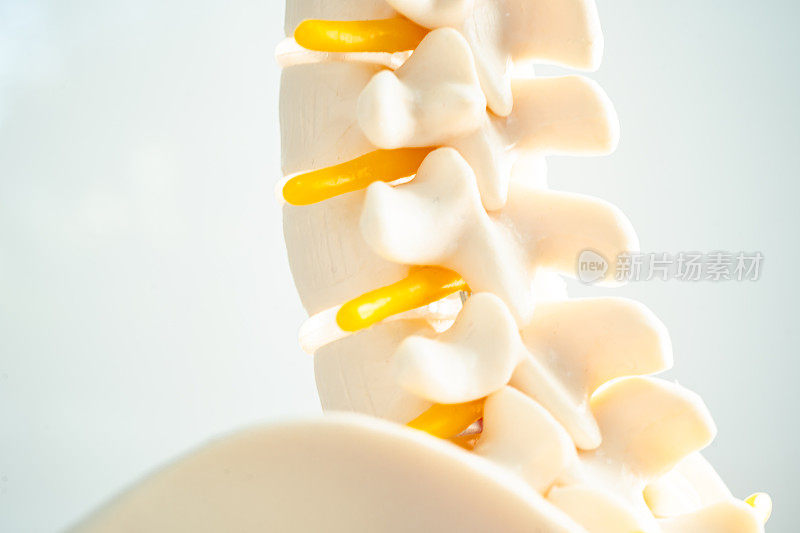 腰椎移位，椎间盘碎片突出，脊神经和骨头突出。骨科治疗医学典范。