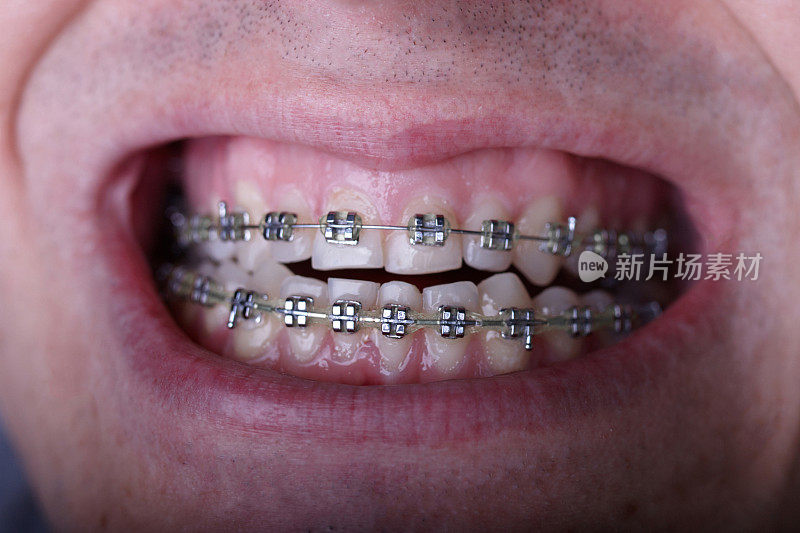 金属矫正牙套对弯曲丑陋的牙齿近距离。丑陋的微笑。牙科概念，医学对齐牙齿，托槽矫正医生