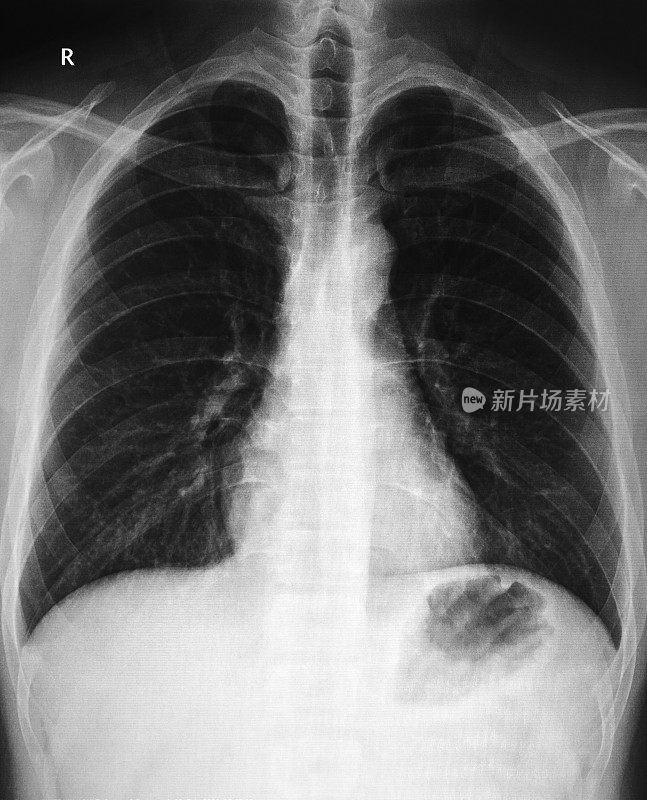 肺部x光