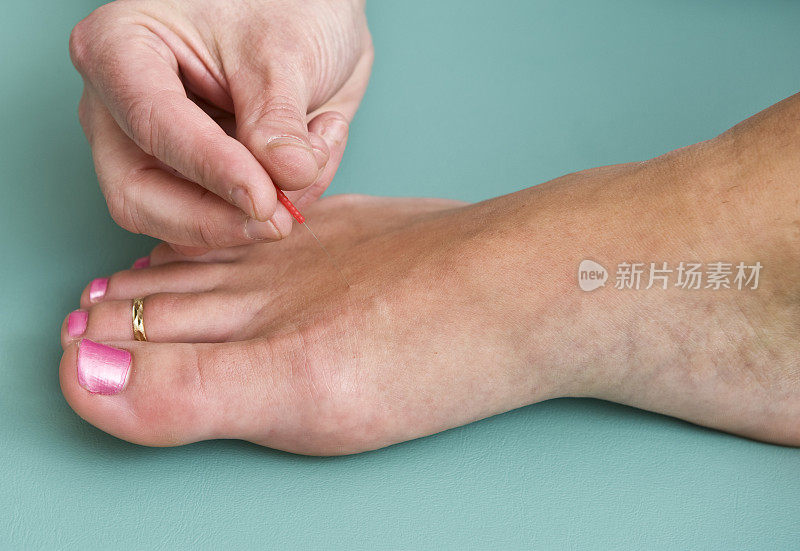 医生的手在一个女人的脚上插入针灸针