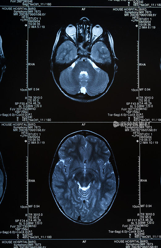 MRI脑部扫描显示头部和头骨的多个图像