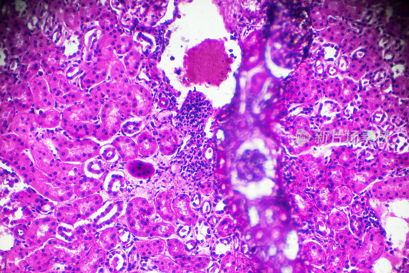 显微镜下急性肾盂肾炎活检标本