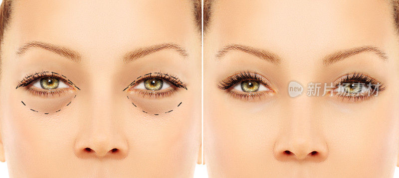 眼睑整容术。眼睑整容术。标志着脸。女性面部穿孔纹，整形外科概念。
