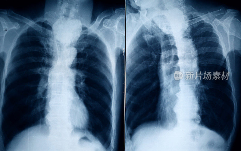 胸部x光图像