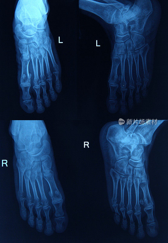足部的x光图像