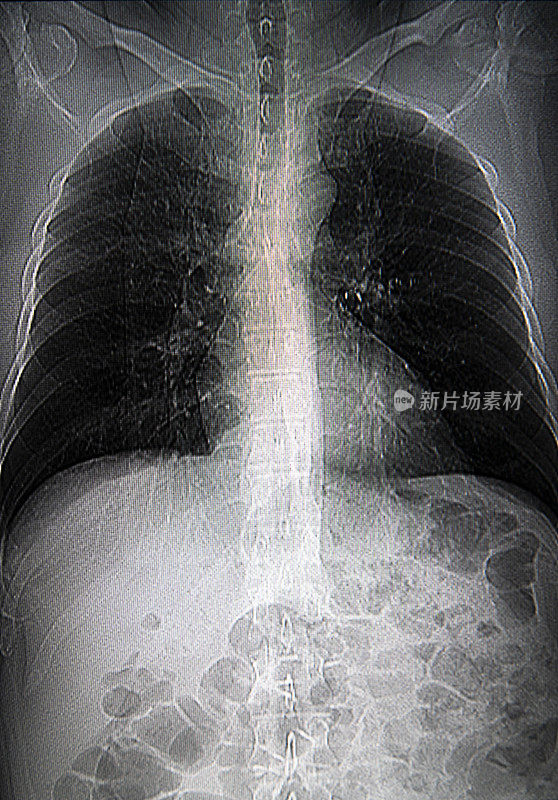胸部器官的计算机断层扫描。CT扫描。