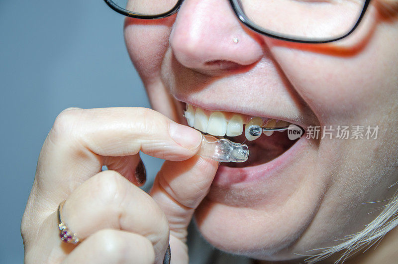 一个女人移除塑料隐形牙套的特写镜头。