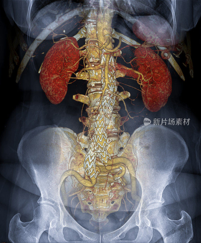 CTA腹主动脉三维成像与腹部x线图像融合。
