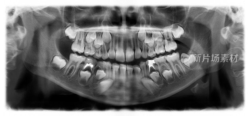 全景x光片是一种上下颌的全景扫描牙科x光片。这是焦平面断层扫描显示的是一个七岁小孩的上颌骨和下颌骨。