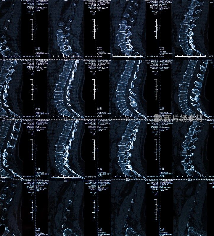 脊柱x射线胶片