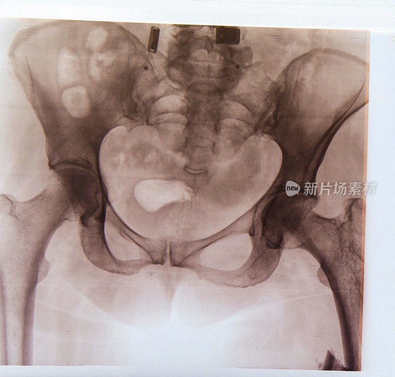 骨盆、x射线
