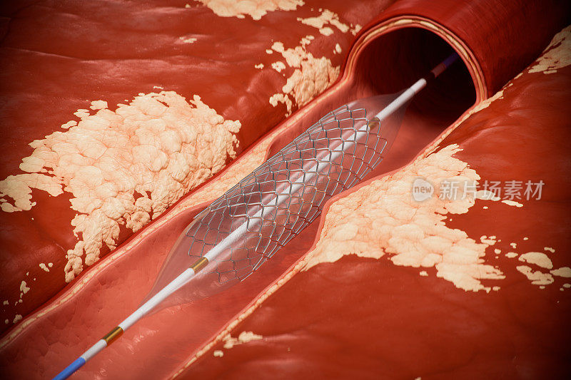 支架与球囊血管成形术的医学说明