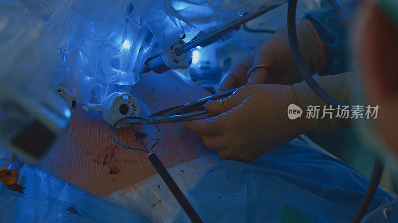 一队医生和护士在黑暗中一起做腹腔镜手术