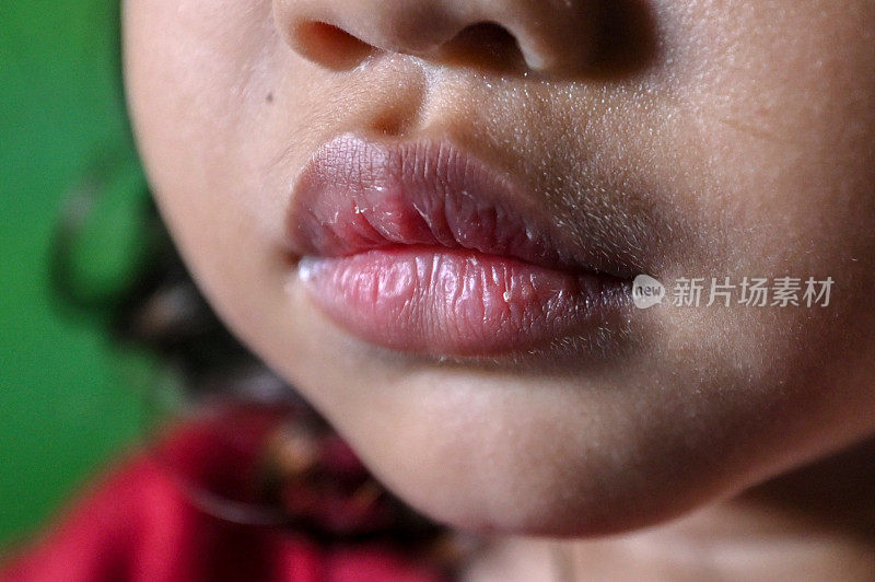 儿童的嘴唇缺乏维生素c