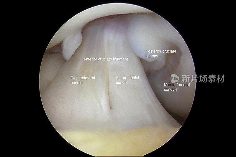 一名成年男性右膝正常外观的前交叉韧带(ACL)的关节镜视图