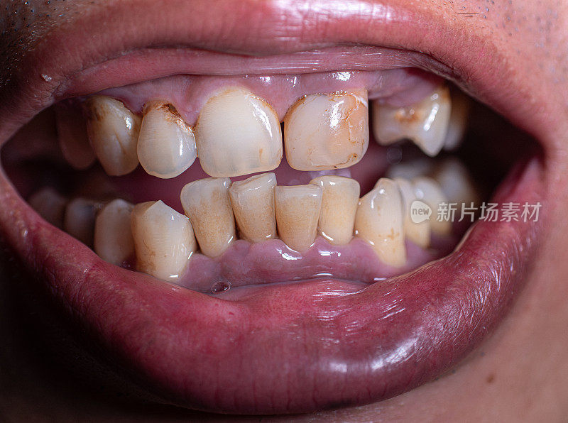口腔和牙齿健康状况不佳、蛀牙、牙龈疾病和牙龈肿胀都会导致牙痛。牙齿被染黑，牙菌斑又脏又黄。