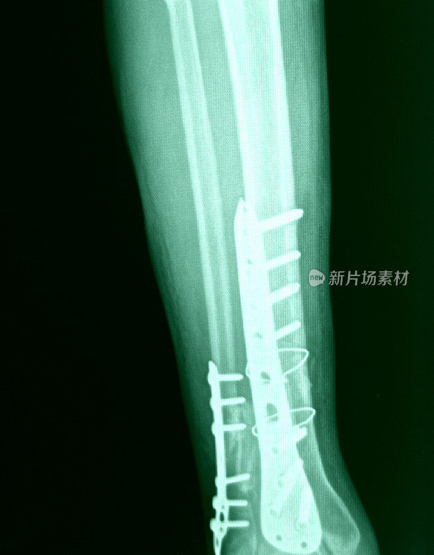 膝关节x光骨人类腿部解剖学