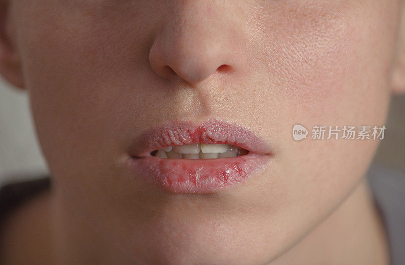 Dermatillomania皮肤挑选。女人有舔嘴唇的坏习惯。由焦虑、压力和嘴唇干燥导致的有害成瘾。剥皮障碍。生病的、开裂的、受损的组织。
