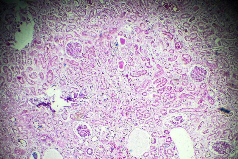 显微镜下急性肾炎活检标本