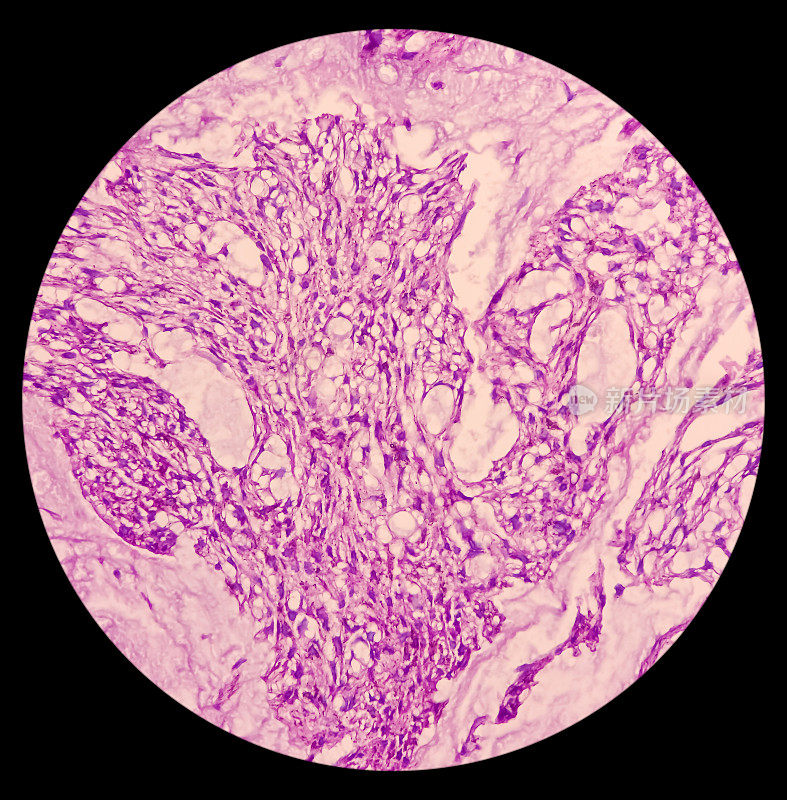 骶骨SOL，脊索瘤显微照片。显示软组织和骨性组织、恶性肿瘤、黏液样细胞间组织、发浆细胞、空泡状细胞质。