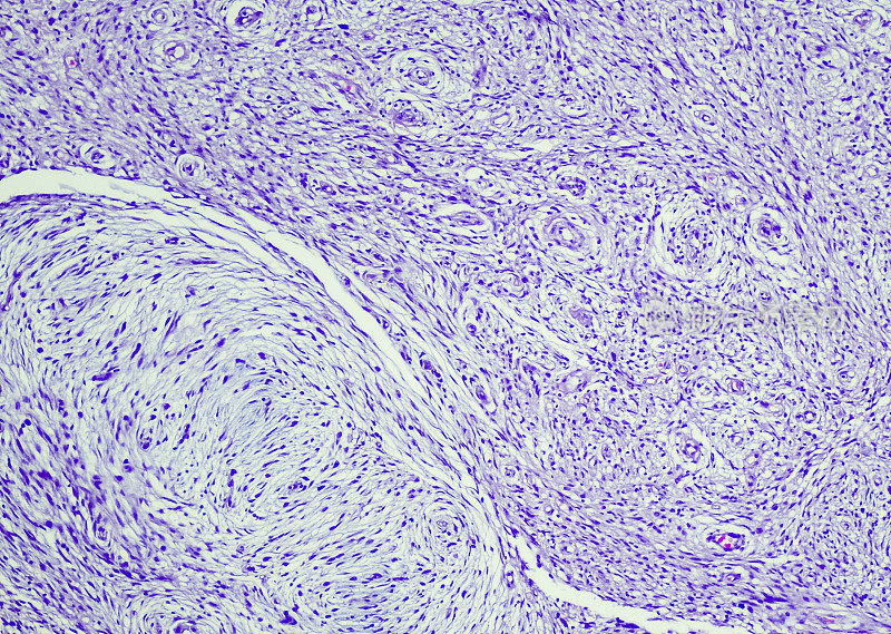 Myxofibrosarcoma