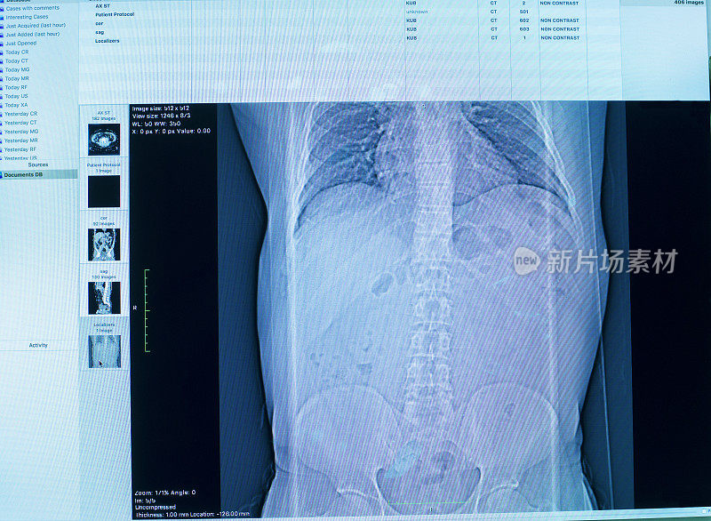 CT扫描