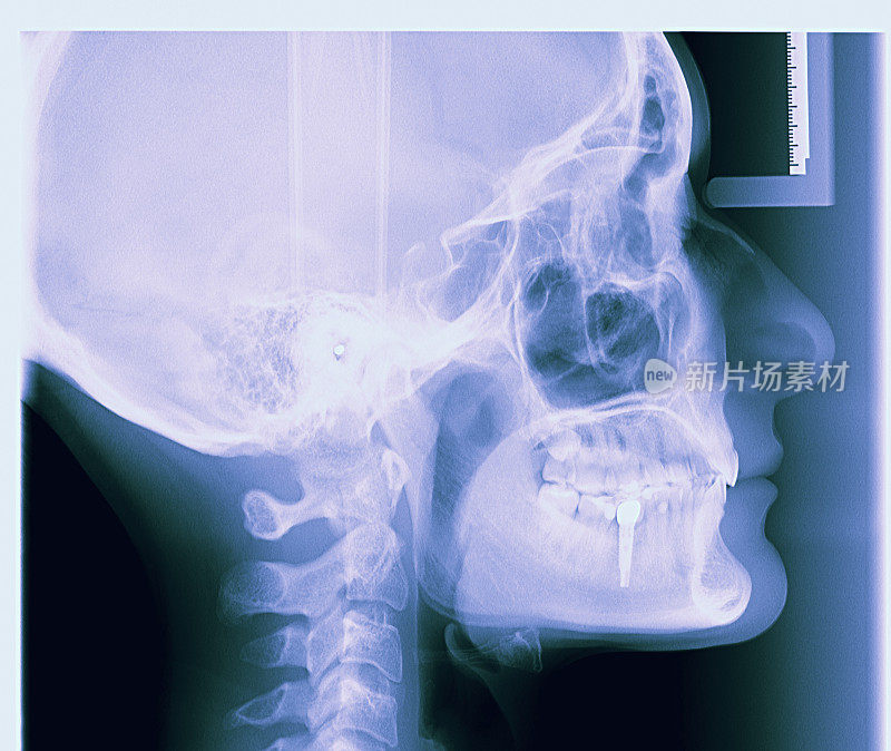 牙科x光检查含种植体的牙齿