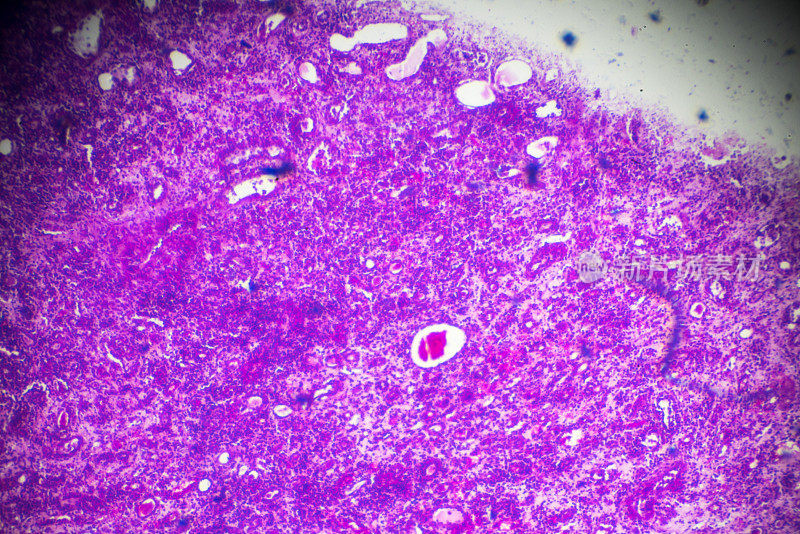 显微镜下硬化性肾小球肾炎活检标本