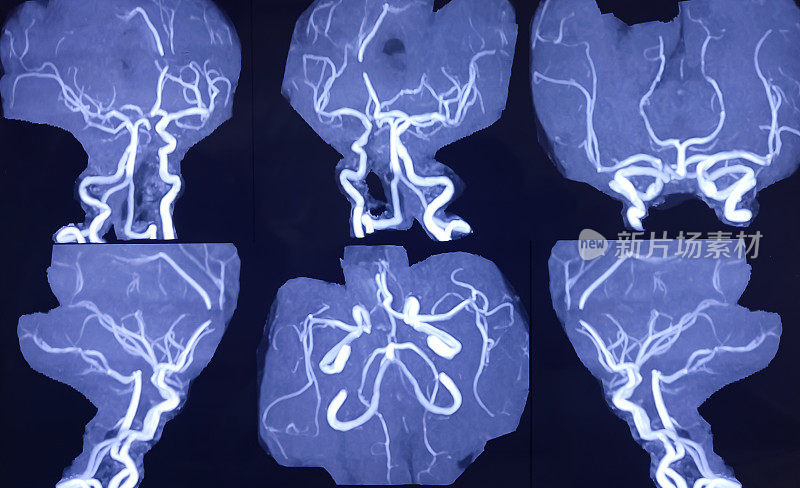 脑核磁共振成像和核磁共振成像。脑部显示脑软化伴广泛胶质增生及左额叶凸出病变。