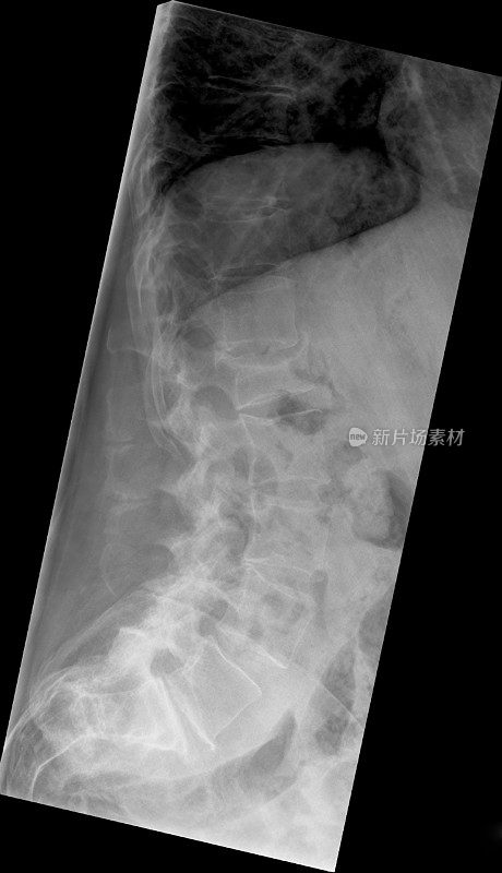 指型腰椎x线片在骨质疏松伴椎体骨折中的应用