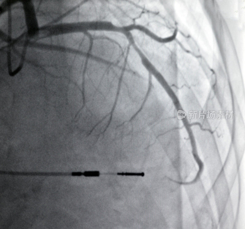 冠状动脉粥样硬化DSA图像