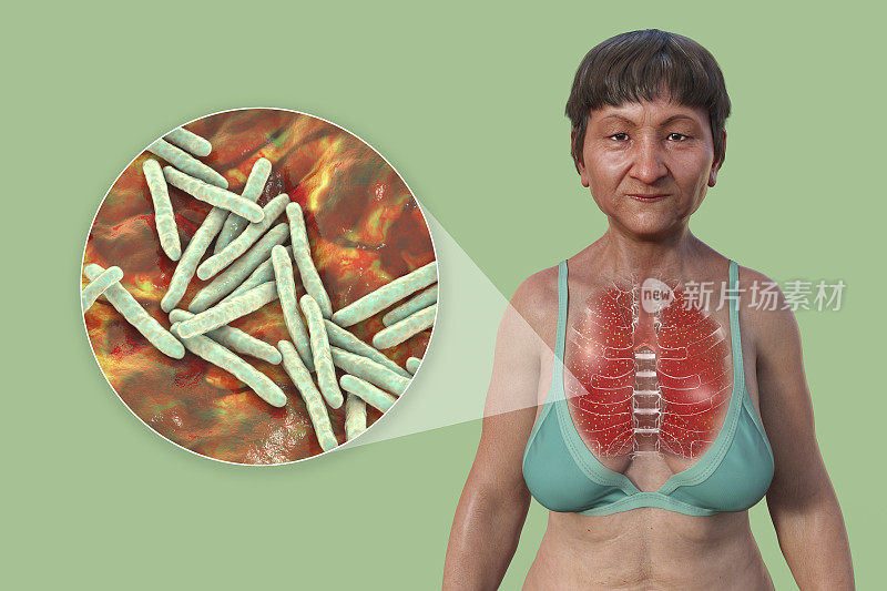 一个透明皮肤的女人的三维插图，展示了受军旅性肺结核影响的肺部和结核分枝杆菌细菌的特写