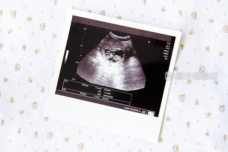 孕期超声图像