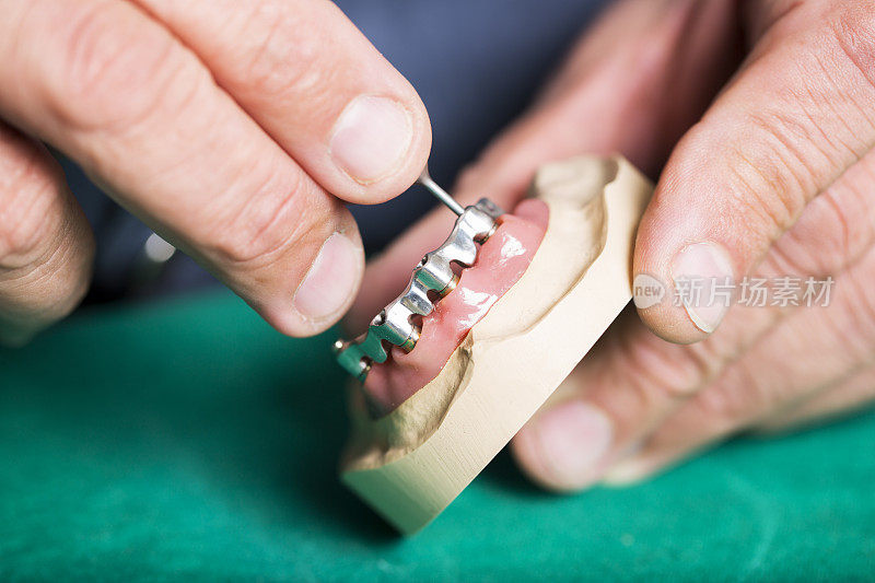 牙科植体……牙科技师正在为牙医准备假牙